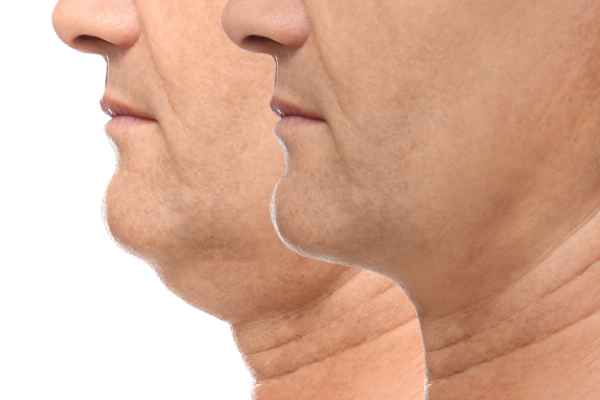 HIFU - Breakthrough in Anti - ageing 2 hifu results Billericay