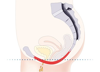 Pelvic-Floor Muscle Repair 5 Pelvic floor muscles Billericay