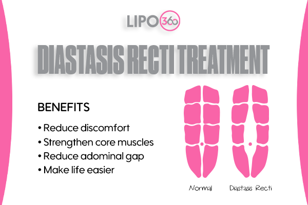 Revolutionising Muscle Repair: The Power of LIPO360 Body Sculpt Post-Injury 5 diastasis recti treatment Billericay