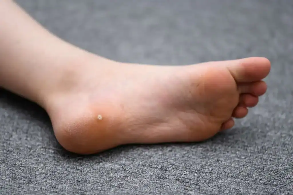 Cryotherapy For Warts And Also Verrucas 2 Image of verruca on the bottom of the foot that able to be treated with Cryotherapy Billericay