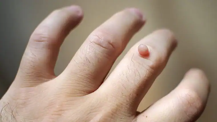 Image of blemish that Cryotherapy Billericay can remove with Lipo 360.