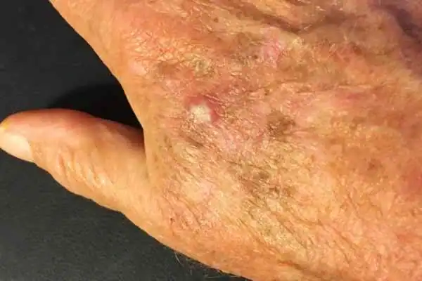 Cryopen For Actinic Keratoses 1 Image of Actinic keratoses Billericay on a person hand