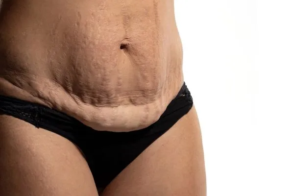 The science behind skin tightening Billericay picture of a woman's sagging skin on the stomach
